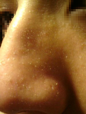 鼻妹急速飛針24 鼻妹急速飛針24