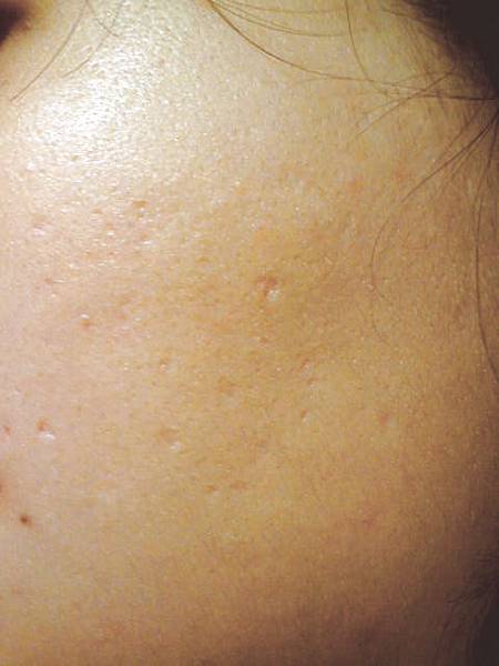 鼻妹急速飛針28 鼻妹急速飛針28