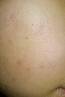 鼻妹急速飛針29 鼻妹急速飛針29