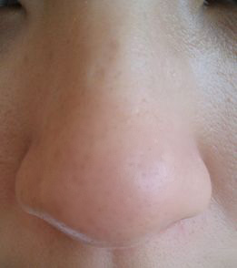 鼻妹急速飛針25 鼻妹急速飛針25