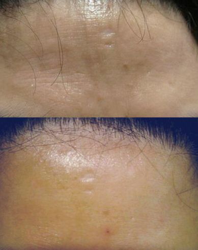 鼻妹急速飛針30 鼻妹急速飛針30