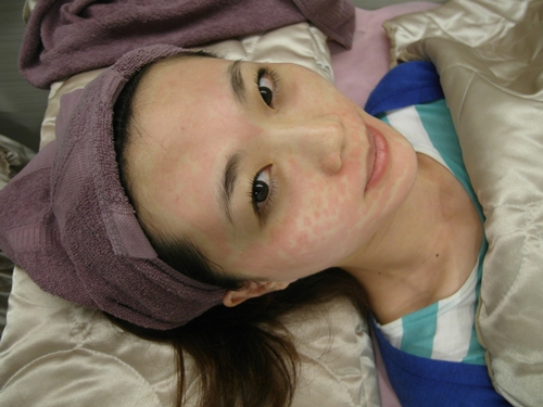 花蕾淨膚雷射17 花蕾淨膚雷射17