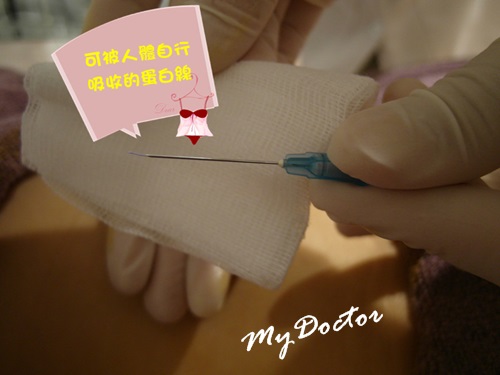 埋線體雕10 埋線體雕10