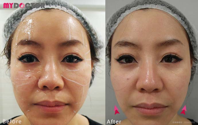 B+A1 B+A1