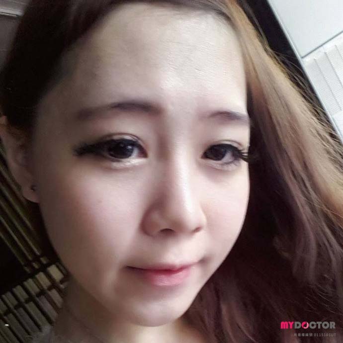 術後照2 術後照2