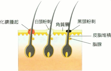 粉刺成因2.jpg