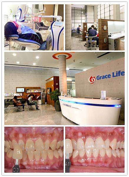 台中冷光美白推薦+台中牙齒美白價格+生活牙醫評價