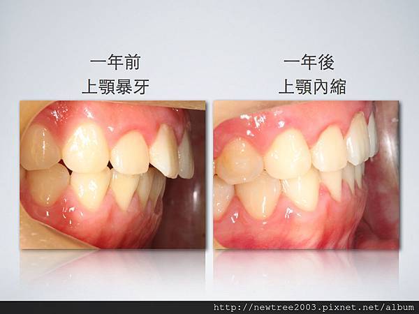 隱適美改善暴牙 隱適美改善暴牙