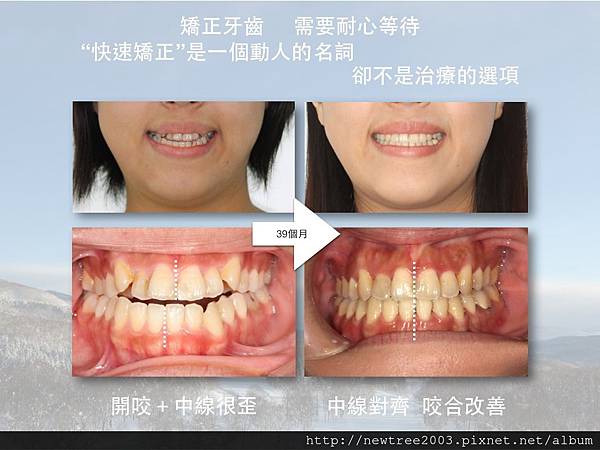 快速矯正 快速矯正