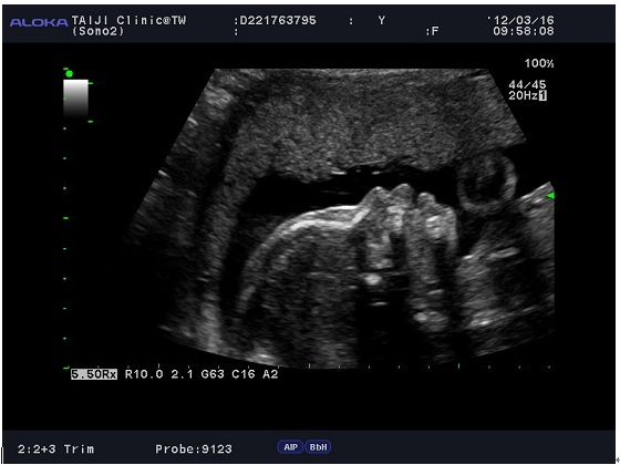 高層次超音波 高層次超音波