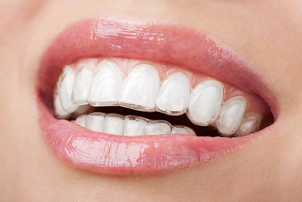 Invisalign-Close Invisalign-Close