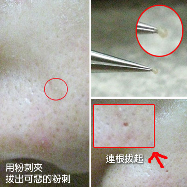 拔粉刺