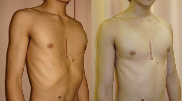 傳統手術後若胸壁仍有部份凹陷, 可以再用微創手術矯治.