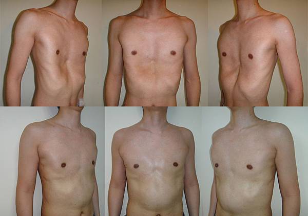 30歲病友手術後 30歲病友手術後