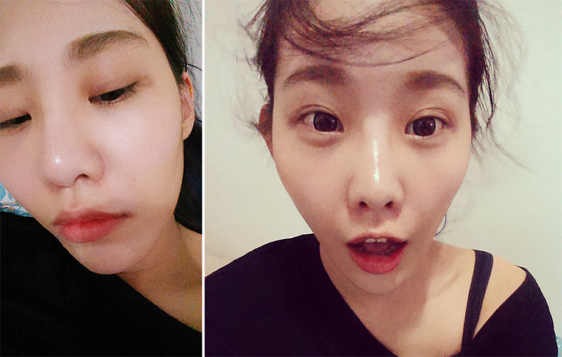 [医美] 超自然的啦!偷偷打了苹果肌+法令纹 - _3