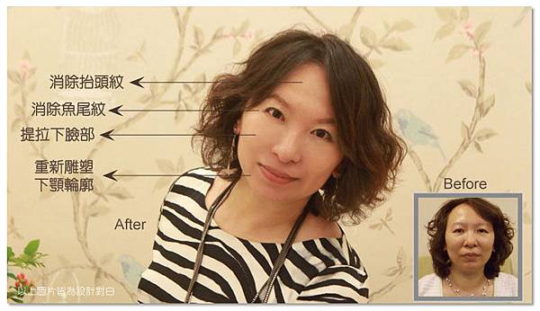 台中電波拉皮菲仕美13