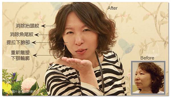 台中電波拉皮菲仕美14