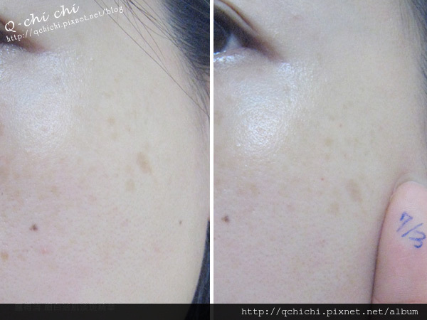 露得清-細白活肌淡斑精華-使用前後