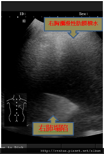 案例一 王先生，59歲， 30年老菸槍，咳嗽，喘氣10天。 診斷：右胸瀰漫性積水，右肺塌陷。