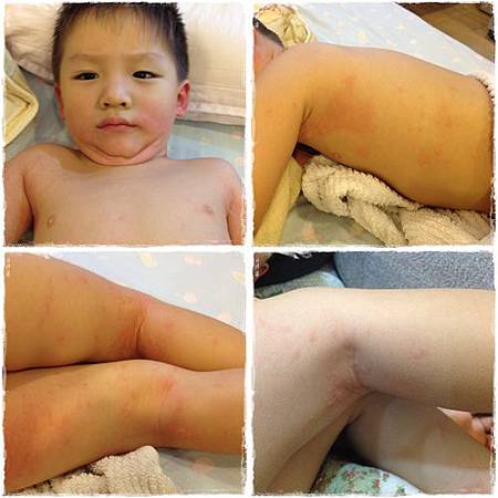 3y8m 蕁麻疹.jpg