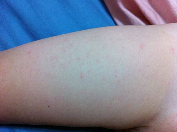 病毒疹.JPG 病毒疹.JPG