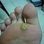 10幾年的尋常疣*魚鱗贅*足底疣*.......冷凍治療後皮膚腫脹疼痛..腳底明顯的看到6顆疣..無法走路..