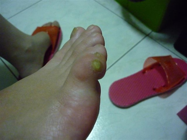 無知的第一次冷凍疼痛腫脹的小拇指~