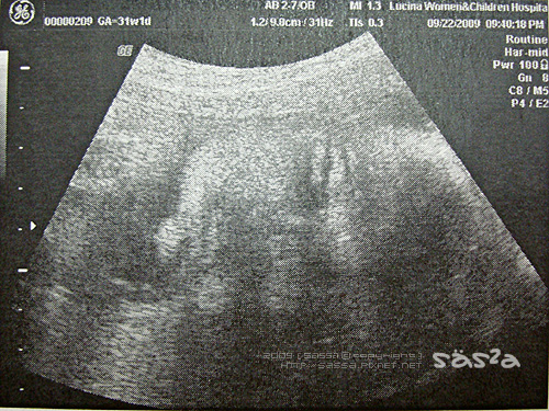 30W1D眼睛像麻迷
