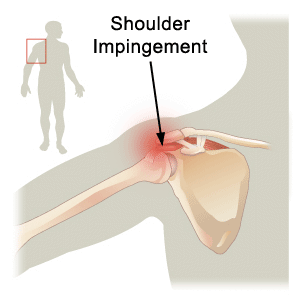 impingement.gif