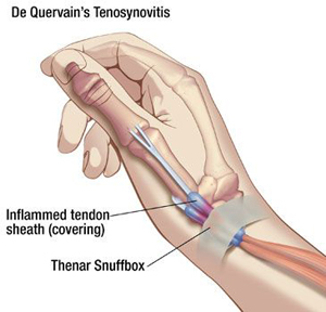 de-quervains-tenosynovitis-computer-mouse.jpg