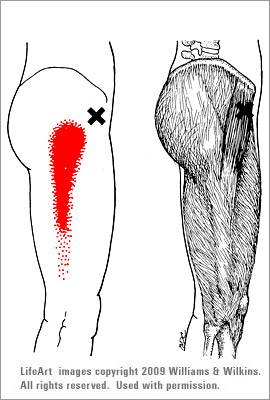 tensor_fasciae_latae01.jpg