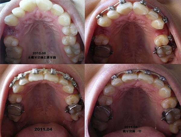 上排牙齒.jpg