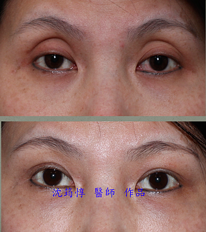 眼窩凹陷 眼窩凹陷