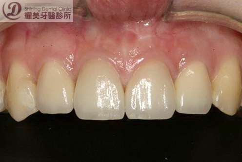 v621