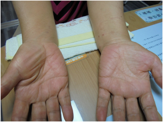 1030501 正中神經壓迫 導致魚際萎縮