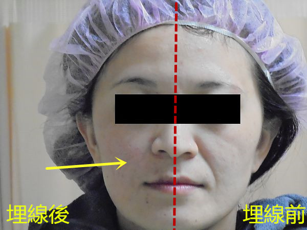 4D法令紋術前術後 4D法令紋術前術後