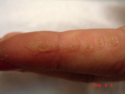 Porokeratosis - Wikipedia