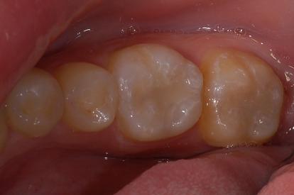 牙齒5