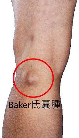 bakers-cyst-3