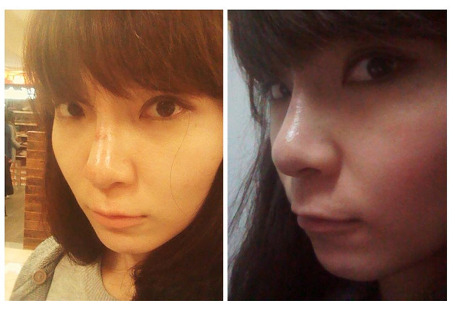 星采大安_韓式隆鼻+墊下巴+抽脂補臉_Cindy03 星采大安_韓式隆鼻+墊下巴+抽脂補臉_Cindy03