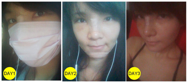 星采大安_韓式隆鼻+墊下巴+抽脂補臉_Cindy07 星采大安_韓式隆鼻+墊下巴+抽脂補臉_Cindy07