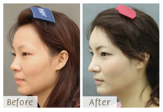 星采大安_韓式隆鼻+墊下巴+抽脂補臉_Cindy08 星采大安_韓式隆鼻+墊下巴+抽脂補臉_Cindy08