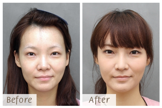 星采大安_韓式隆鼻+墊下巴+抽脂補臉_Cindy09 星采大安_韓式隆鼻+墊下巴+抽脂補臉_Cindy09