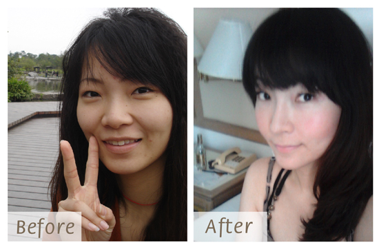 星采大安_韓式隆鼻+墊下巴+抽脂補臉_Cindy11 星采大安_韓式隆鼻+墊下巴+抽脂補臉_Cindy11