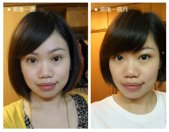 星和台北_雙眼皮_Ada04 星和台北_雙眼皮_Ada04