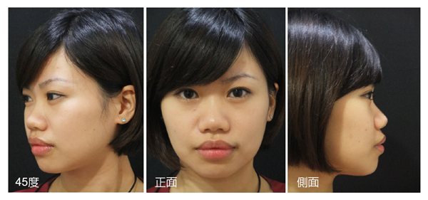 星和台北_雙眼皮_Ada06 星和台北_雙眼皮_Ada06