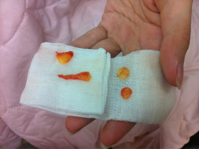 星和台北_雙眼皮_杞孟衿醫師10 星和台北_雙眼皮_杞孟衿醫師10