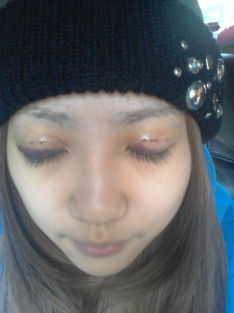 星和台北_雙眼皮_杞孟衿醫師12 星和台北_雙眼皮_杞孟衿醫師12