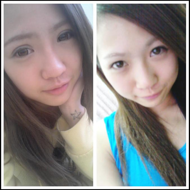 星和台北_雙眼皮_杞孟衿醫師14 星和台北_雙眼皮_杞孟衿醫師14