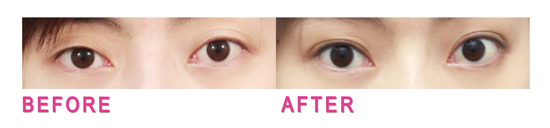 星采大安_雙眼皮_邱大睿院長02 星采大安_雙眼皮_邱大睿院長02